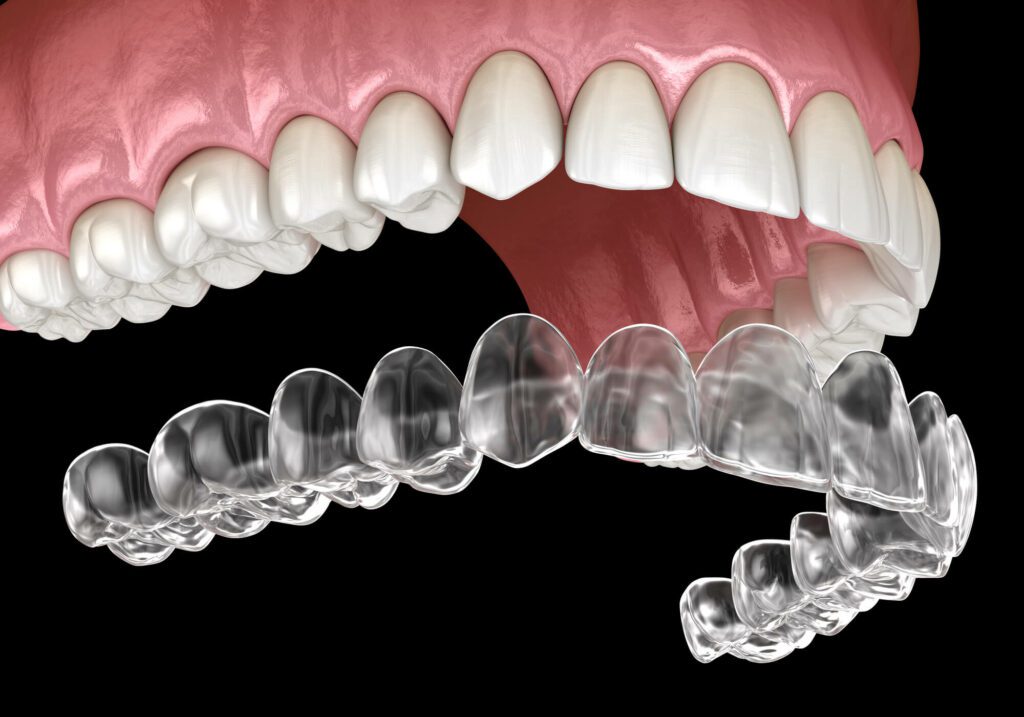 Invisalign Attachments  Orthodontist Gaithersburg MD Invisalign